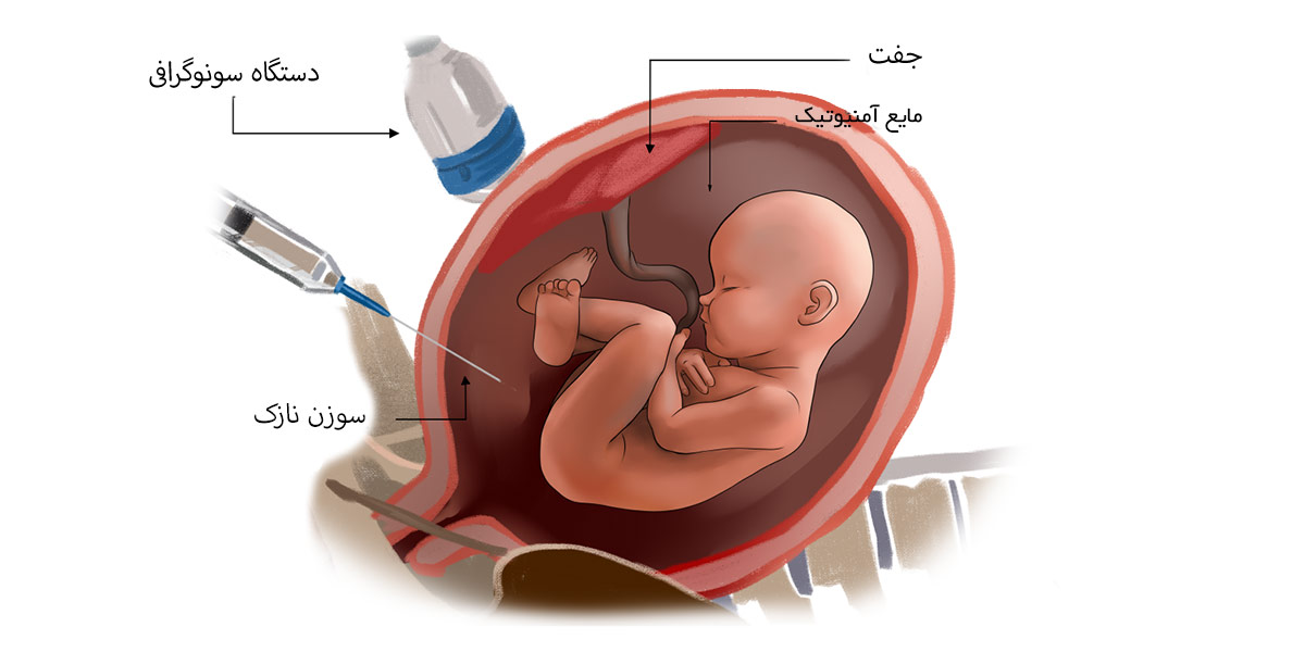 روش‌ درمان افزایش آب دور جنین