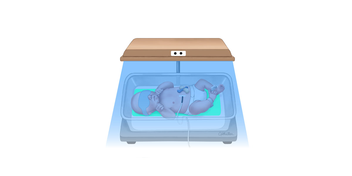 نوزاد در دستگاه فتوتراپی