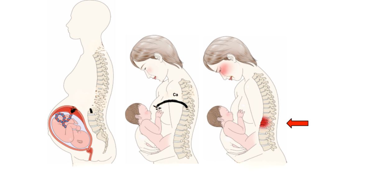 پوکی استخوان در مادران نوجوان در دوران بارداری