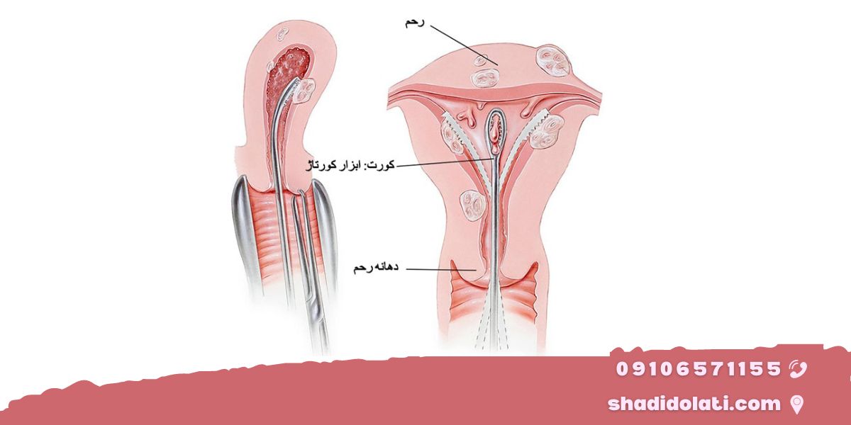 چگونه کورتاژ انجام می‌شود؟