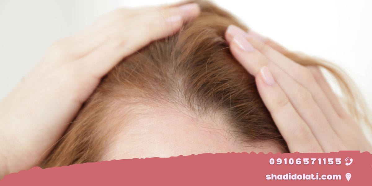 درمان ریزش مو در دوران شیردهی