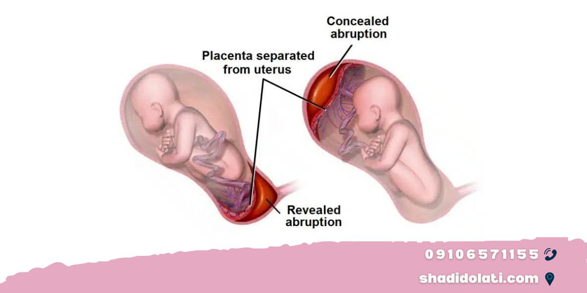 Placental abruption