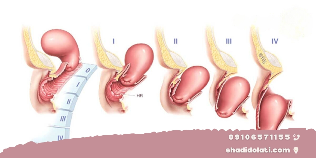  درجات افتادگی رحم